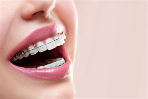 diferencia brackets esteticos y metalicos|brackets precio.